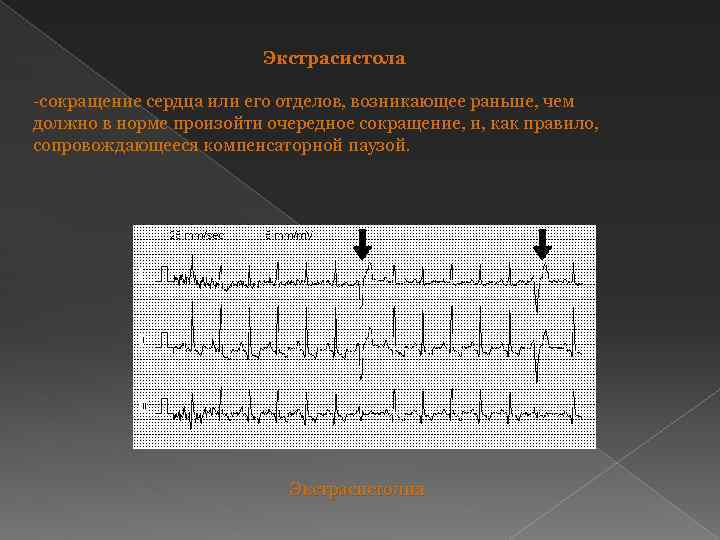 Экстрасистола -сокращение сердца или его отделов, возникающее раньше, чем должно в норме произойти очередное