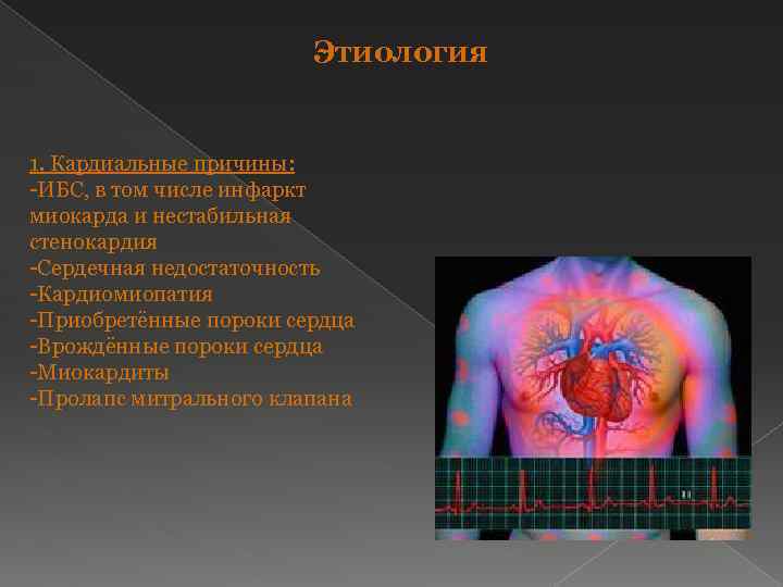 Этиология 1. Кардиальные причины: -ИБС, в том числе инфаркт миокарда и нестабильная стенокардия -Сердечная