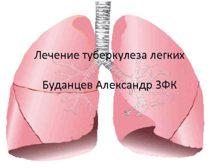 Лечение туберкулеза легких Буданцев Александр 3 ФК