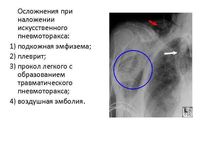 Осложнения при наложении искусственного пневмоторакса: 1) подкожная эмфизема; 2) плеврит; 3) прокол легкого с