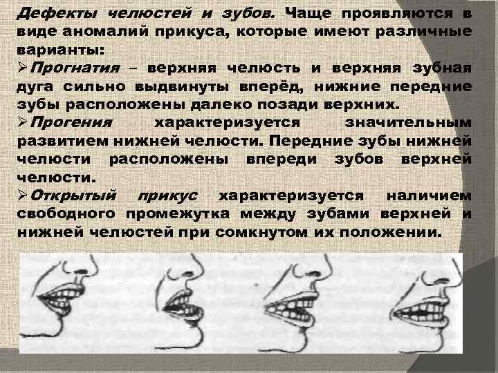 Дефекты челюстей и зубов. Чаще проявляются в виде аномалий прикуса, которые имеют различные варианты: