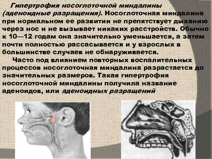 Гипертрофия носоглоточной миндалины (аденоидные разращения). Носоглоточная миндалина при нормальном ее развитии не препятствует дыханию