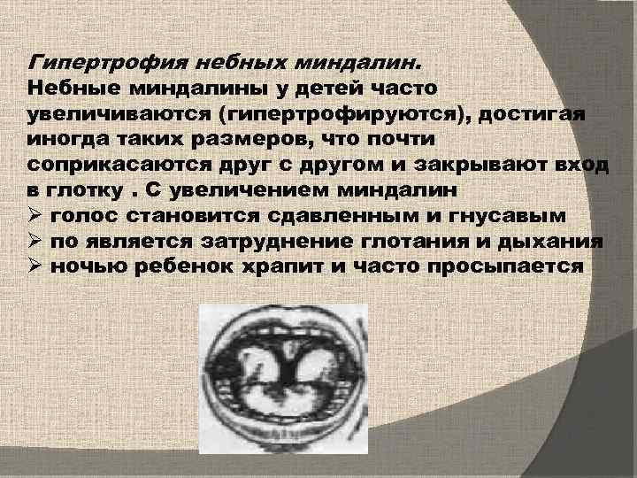 Гипертрофия небных миндалин. Небные миндалины у детей часто увеличиваются (гипертрофируются), достигая иногда таких размеров,