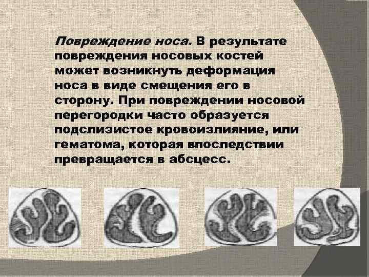 Повреждение носа. В результате повреждения носовых костей может возникнуть деформация носа в виде смещения