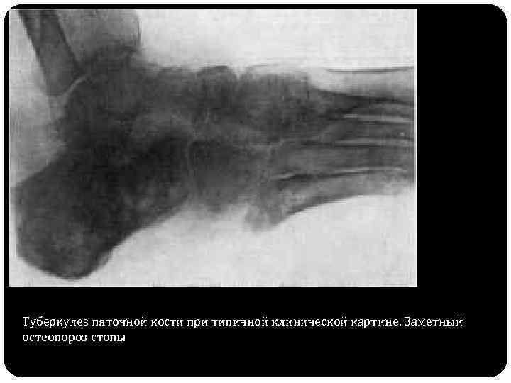 Остеопороз стопы. Туберкулез стопы рентген. Туберкулез кости рентген. Рентгенодиагностика туберкулеза костей. Туберкулез и остеомиелит кости рентген.