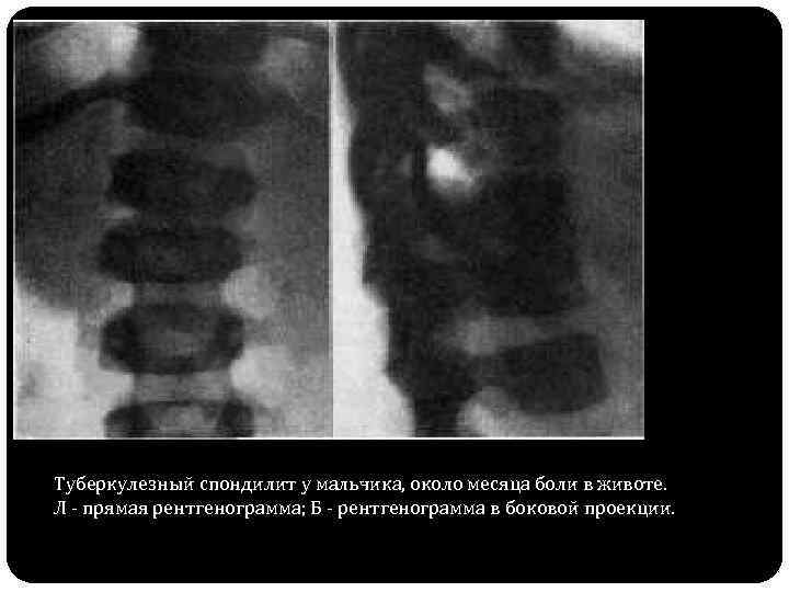 Туберкулезный спондилит у мальчика, около месяца боли в животе. Л - прямая рентгенограмма; Б