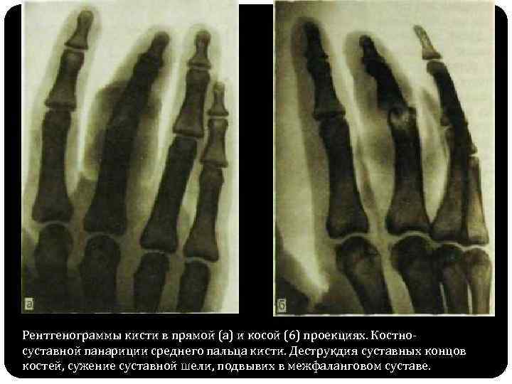 Рентгенограммы кисти в прямой (а) и косой (6) проекциях. Костносуставной панариции среднего пальца кисти.