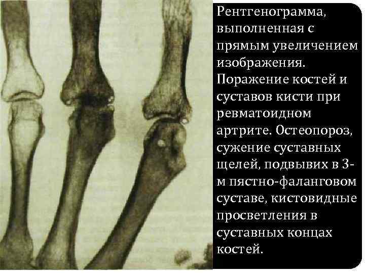 Рентгенограмма, выполненная с прямым увеличением изображения. Поражение костей и суставов кисти при ревматоидном артрите.