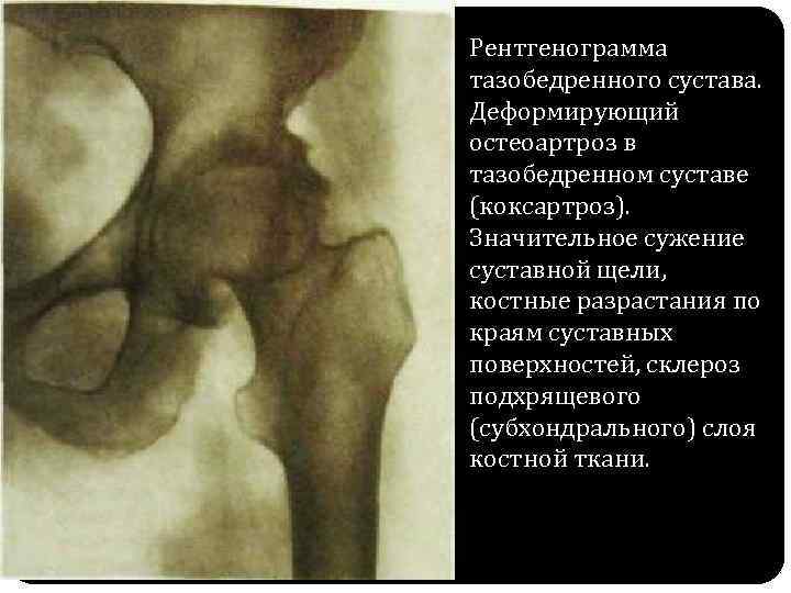 Рентгенограмма тазобедренного сустава. Деформирующий остеоартроз в тазобедренном суставе (коксартроз). Значительное сужение суставной щели, костные