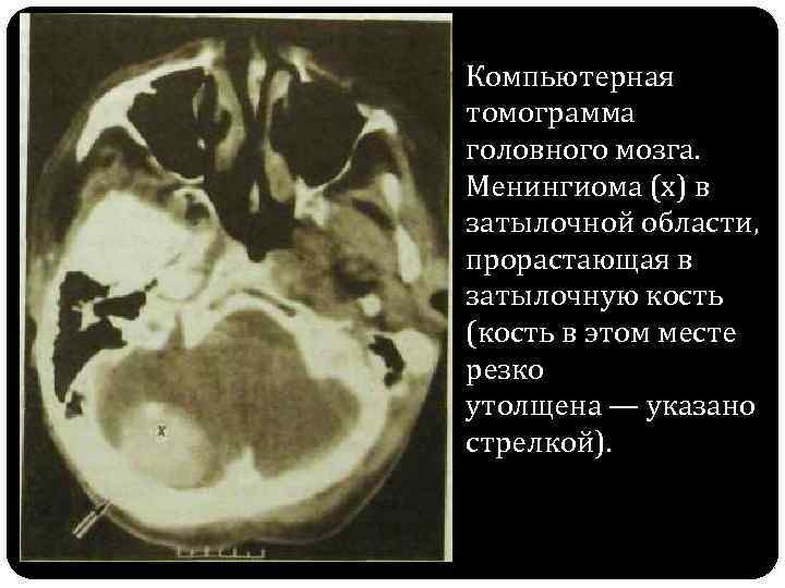 Для рентгенологической картины кистозной формы гигантоклеточной опухоли характерно