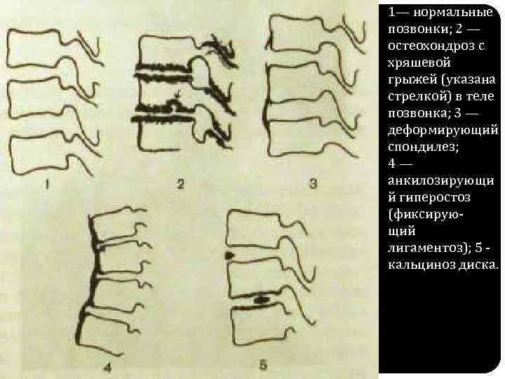 1— нормальные позвонки; 2 — остеохондроз с хряшевой грыжей (указана стрелкой) в теле позвонка;