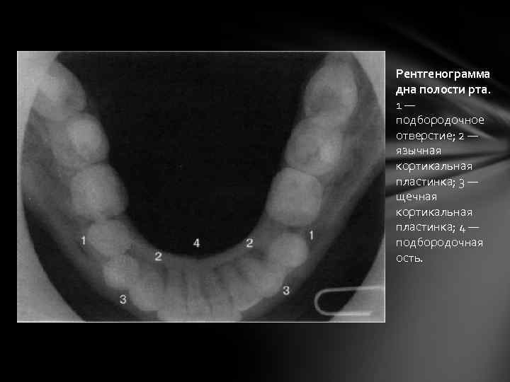 Рентгенограмма дна полости рта. 1— подбородочное отверстие; 2 — язычная кортикальная пластинка; 3 —