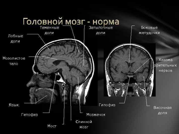 Головной мозг - норма Лобные доли Теменные доли Затылочные доли Мозолистое тело Боковые желудочки