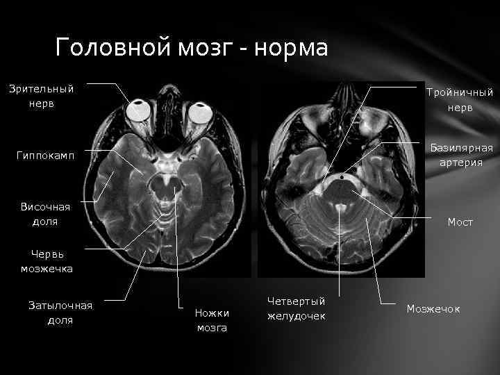 Головной мозг - норма Зрительный нерв Тройничный нерв Гиппокамп Базилярная артерия Височная доля Мост