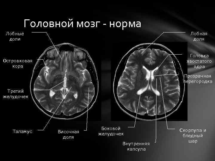 Цистерна мозга норма