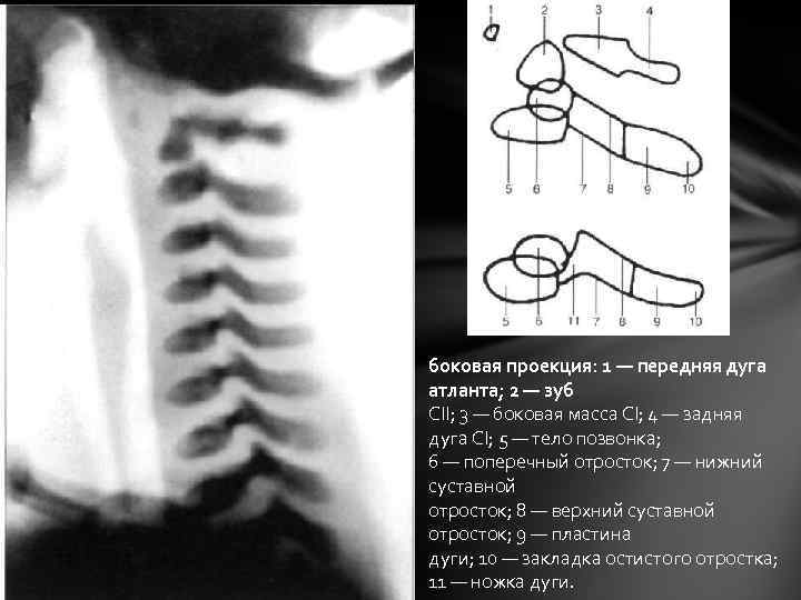 боковая проекция: 1 — передняя дуга атланта; 2 — зуб СII; 3 — боковая