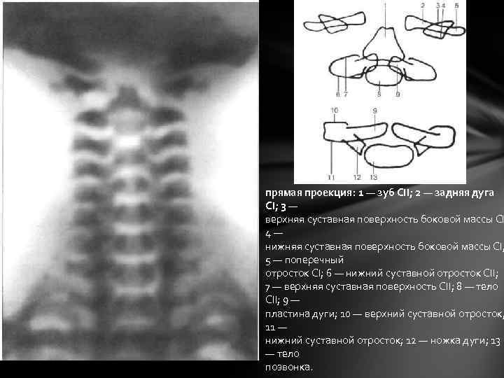 прямая проекция: 1 — зуб СII; 2 — задняя дуга СI; 3 — верхняя