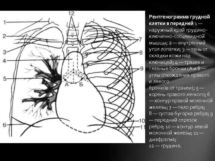 Рентгенограмма грудной клетки в передней 1 — наружный край грудиноключично-сосцевидной мышцы; 2 — внутренний