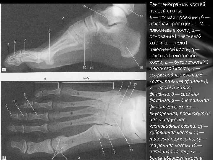 Рентгенограммы костей правой стопы. а — прямая проекция; б — боковая проекция. I—V —