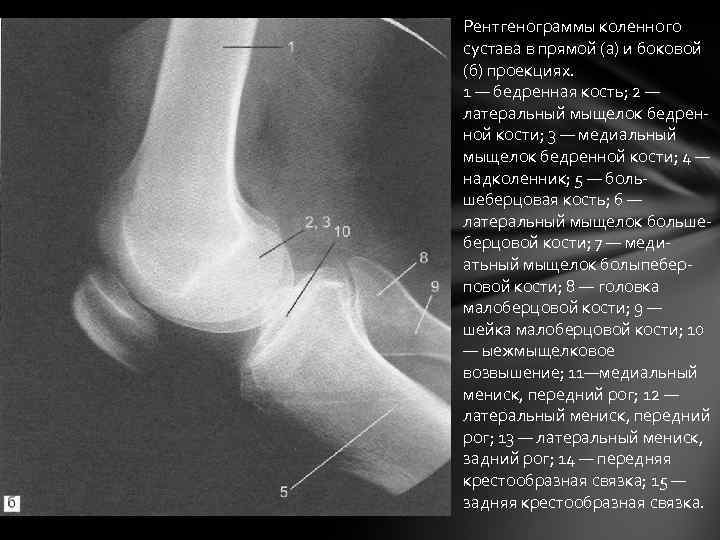 Рентгенограммы коленного сустава в прямой (а) и боковой (б) проекциях. 1 — бедренная кость;