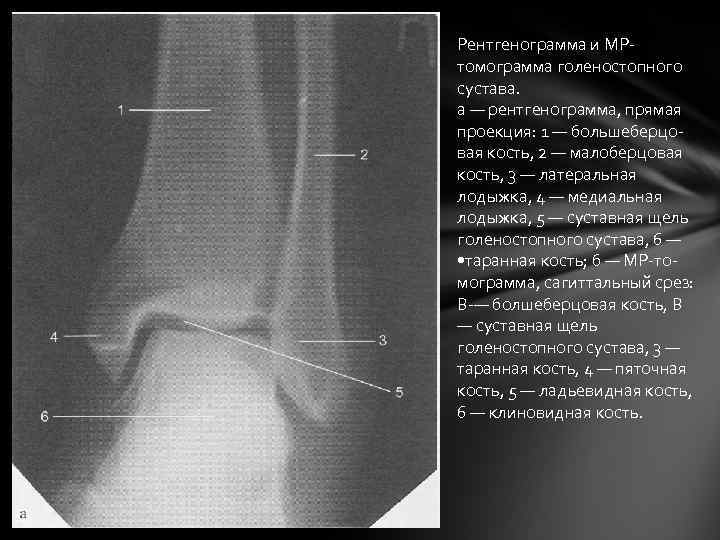 Суставная щель голеностопного сустава. Малоберцовая кость рентген анатомия. Голеностопный сустав рентген анатомия рентгеноанатомия. Рентгеновская суставная щель большеберцовой кости. Проекции голеностопного сустава рентген.