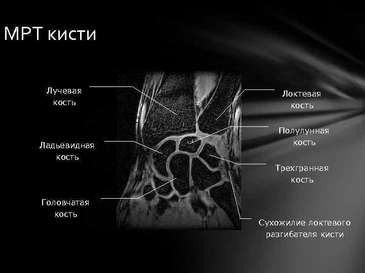 МРТ кисти Лучевая кость Ладьевидная кость Локтевая кость Полулунная кость Трехгранная кость Головчатая кость