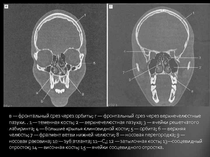 в — фронтальный срез через орбиты; г — фронтальный срез через верхнечелюстные пазухи. .