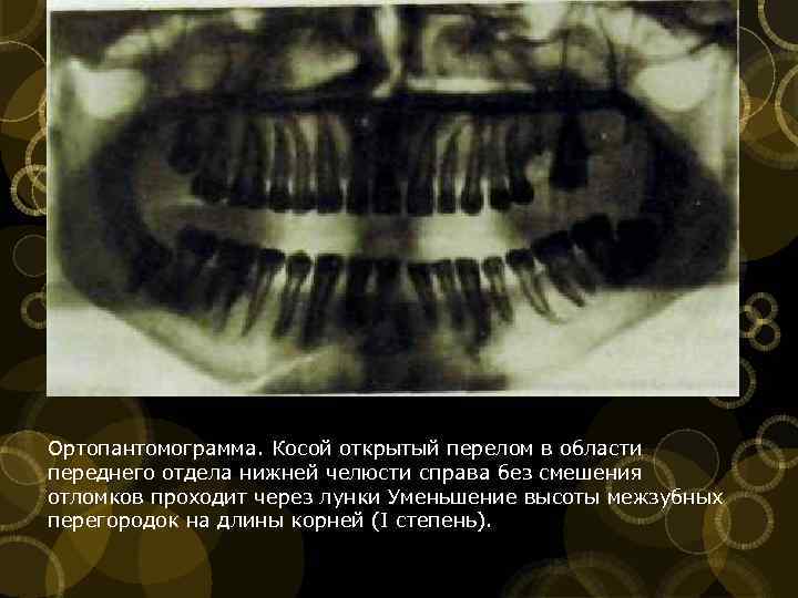 Ортопантомограмма. Косой открытый перелом в области переднего отдела нижней челюсти справа без смешения отломков