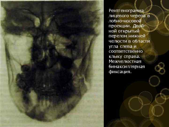 Рентгенограмма лицевого черепа в лобно носовой проекции. Двой ной открытый перелом нижней челюсти в