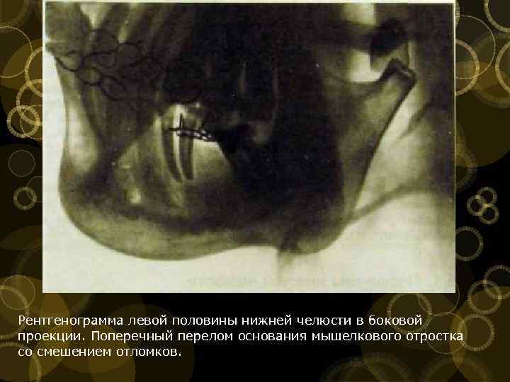 Рентгенограмма левой половины нижней челюсти в боковой проекции. Поперечный перелом основания мышелкового отростка со