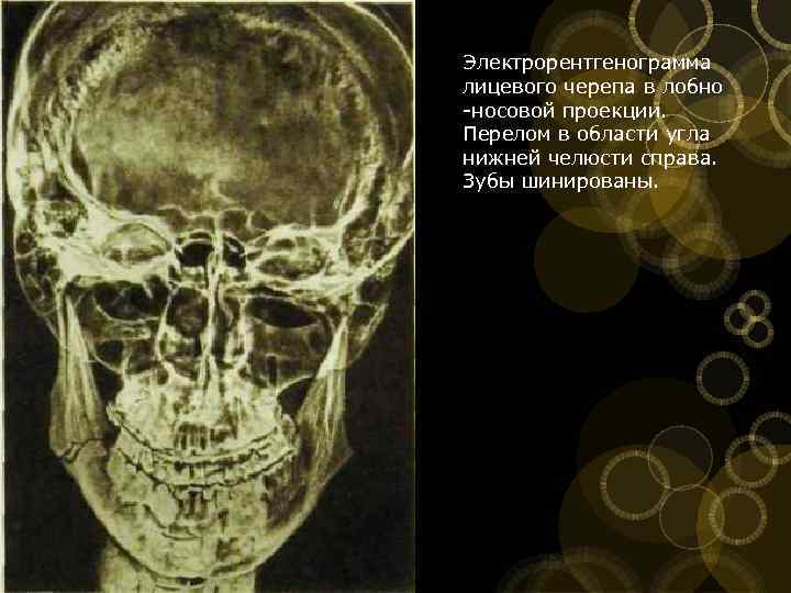 Перелом лицевого черепа. Перелом мыщелкового отростка рентген. Перелом скуловой кости снимок. Перелом Лефор 3 рентген. Перелом мыщелкового отростка нижней челюсти рентгенограмма.