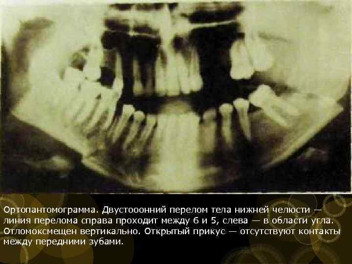 Ортопантомограмма. Двустооонний перелом тела нижней челюсти — линия перелома справа проходит между 6 и