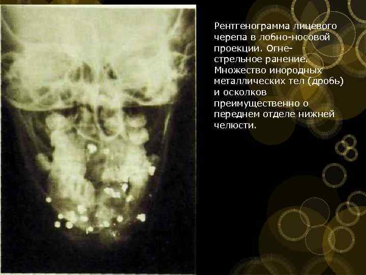 Рентгенограмма лицевого черепа в лобно носовой проекции. Огне стрельное ранение. Множество инородных металлических тел