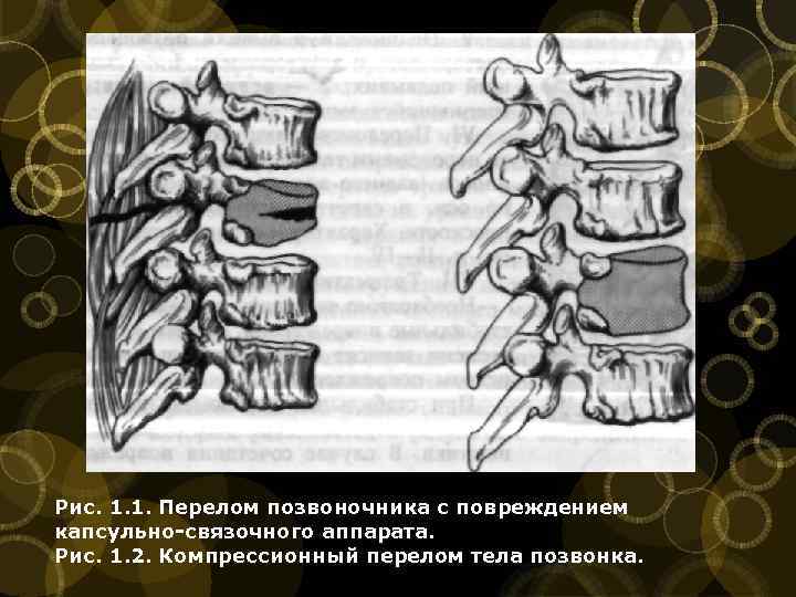 Рис. 1. 1. Перелом позвоночника с повреждением капсульно-связочного аппарата. Рис. 1. 2. Компрессионный перелом