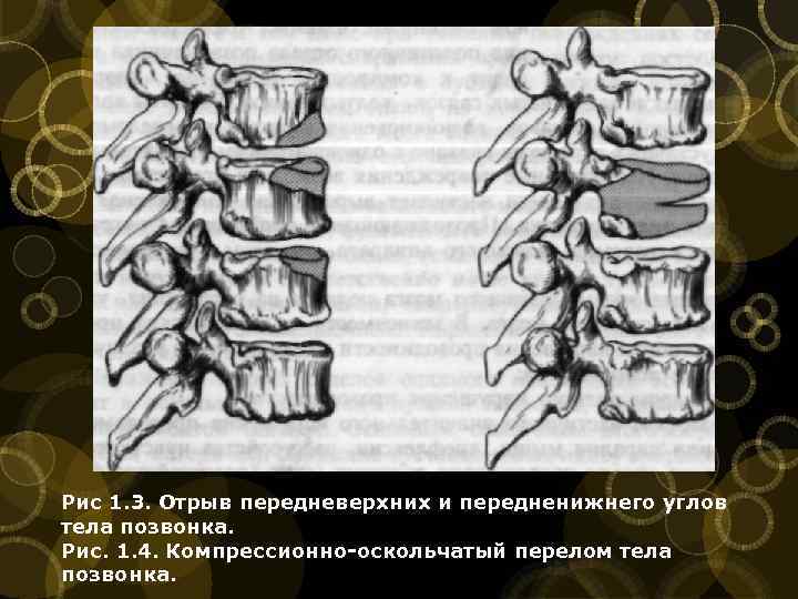 Оскольчатый перелом позвонка