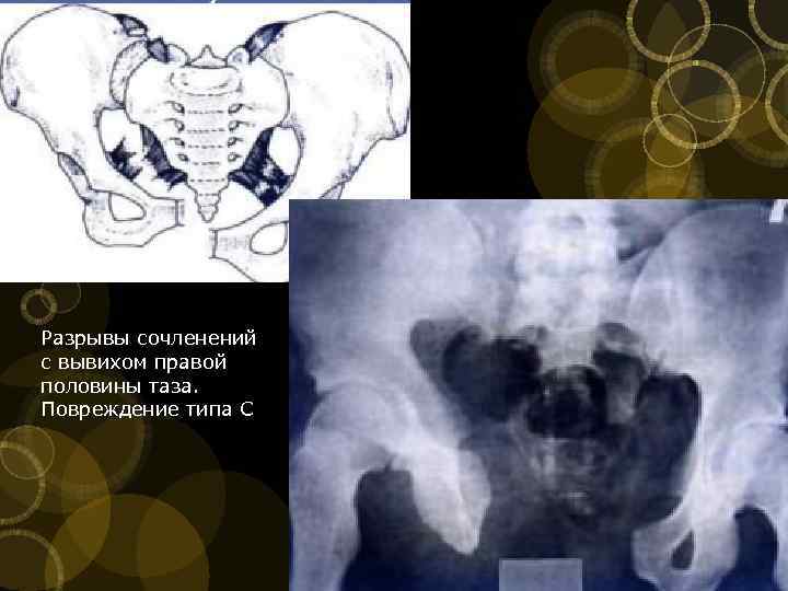 Разрывы сочленений с вывихом правой половины таза. Повреждение типа С 