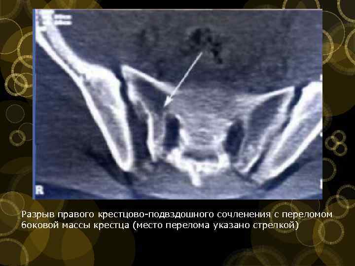 Разрыв правого крестцово подвздошного сочленения с переломом боковой массы крестца (место перелома указано стрелкой)