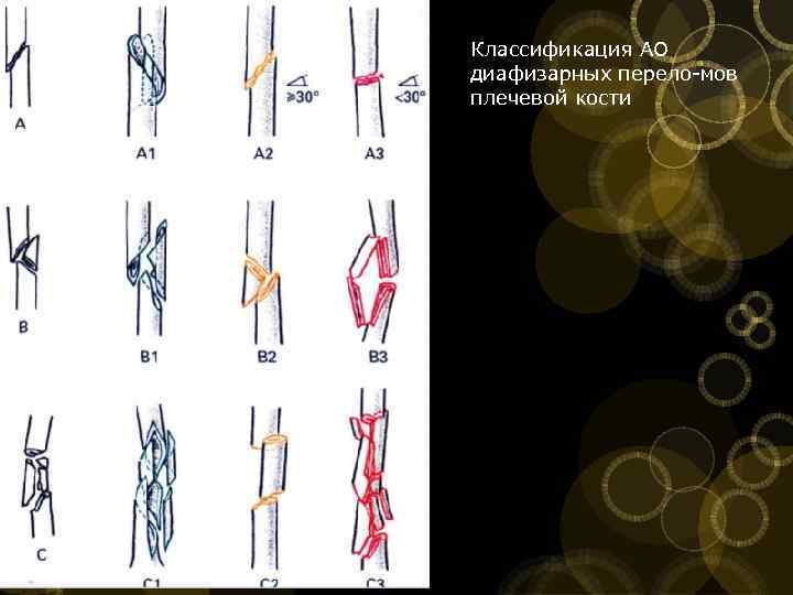 Классификация АО диафизарных перело мов плечевой кости 