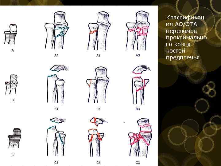 Классификац ия АО/ОТА переломов проксимально го конца костей предплечья 