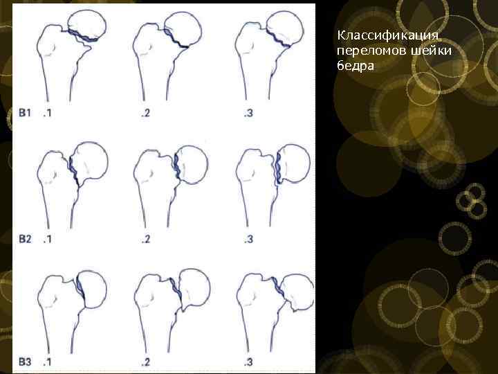 Классификация переломов шейки бедра 