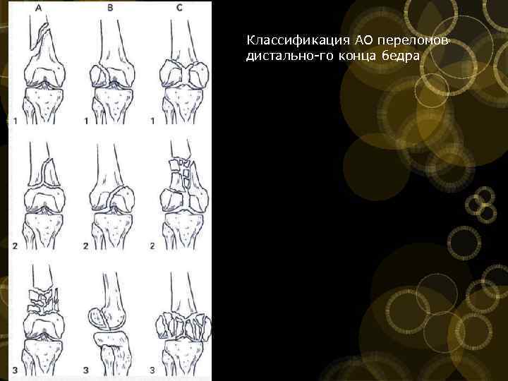 Классификация АО переломов дистально го конца бедра 