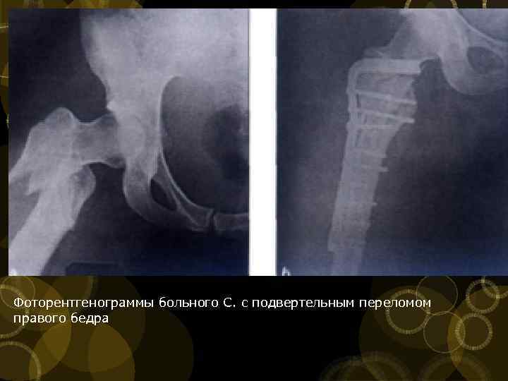 Подвертельный перелом. Подвертельный перелом со смещением. Подвертельный перелом бедренной кости. Подвертельный перелом бедренной кости со смещением отломков. Подвертельный перелом бедра со смещением.