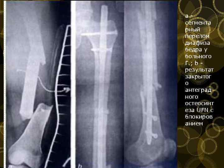 а сегмента рный перелом диафиза бедра у больного Г. ; b результат закрытог о