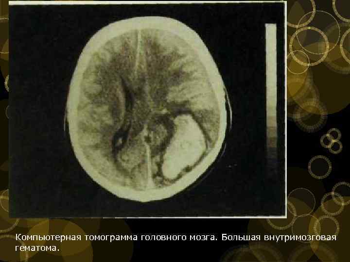 Компьютерная томограмма головного мозга. Большая внутримозговая гематома. 