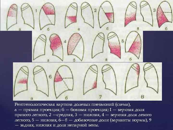 Рентгенологическая картина долевых пневмоний (схема), а — прямая проекция; б — боковая проекция; I