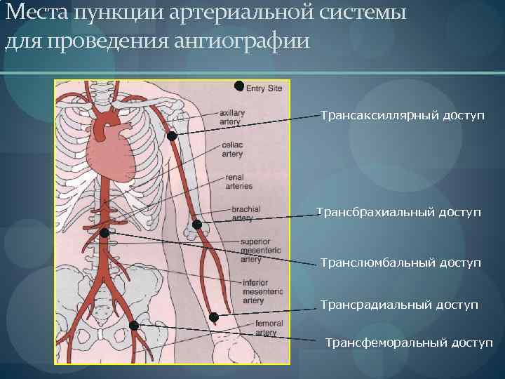 Коронарография в спб. Осложнения ангиографии. Места пункции для ангиографии. Коронарография методика проведения.