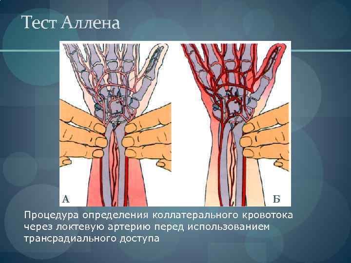 Тест Аллена А Б Процедура определения коллатерального кровотока через локтевую артерию перед использованием трансрадиального