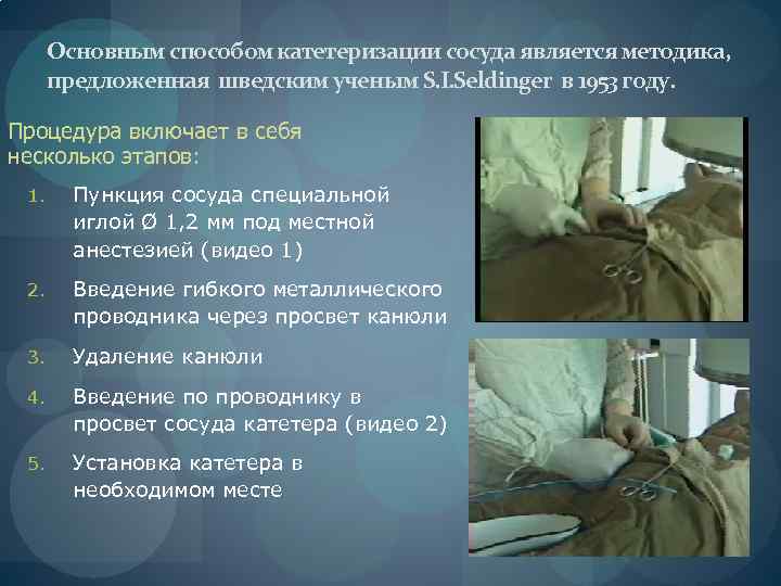 Основным способом катетеризации сосуда является методика, предложенная шведским ученым S. I. Seldinger в 1953