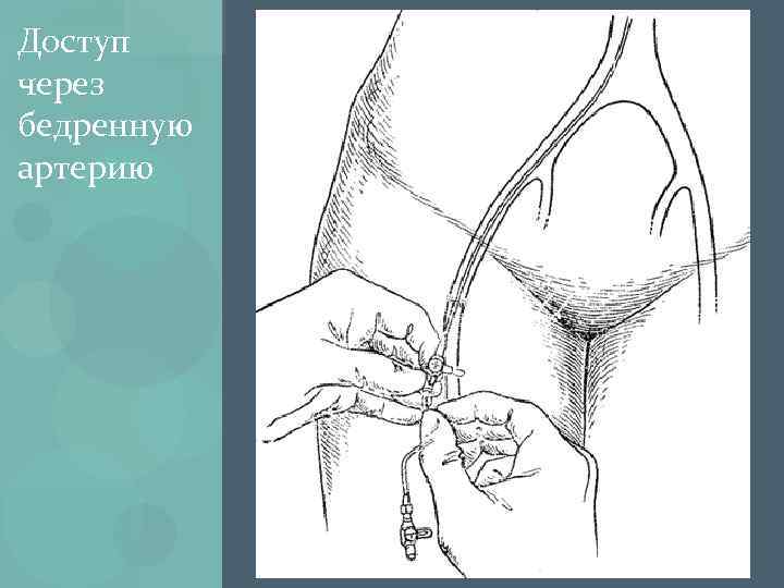 Доступ через бедренную артерию 