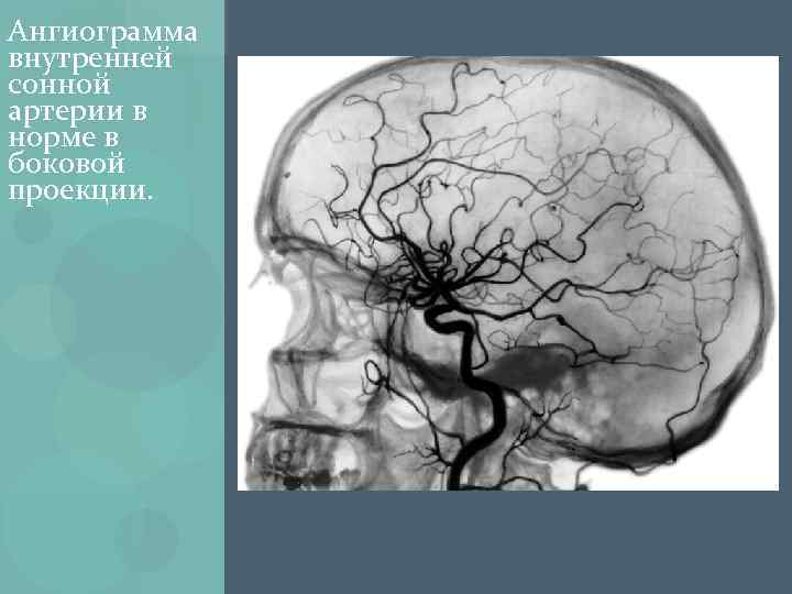 Ангиограмма внутренней сонной артерии в норме в боковой проекции. 
